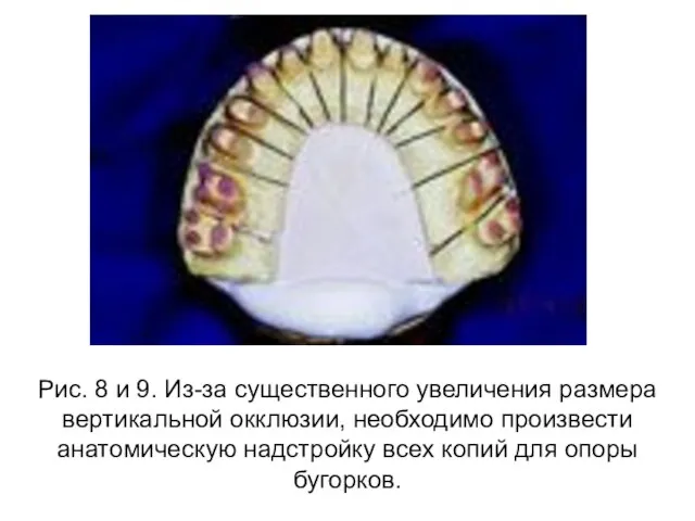 Рис. 8 и 9. Из-за существенного увеличения размера вертикальной окклюзии, необходимо произвести