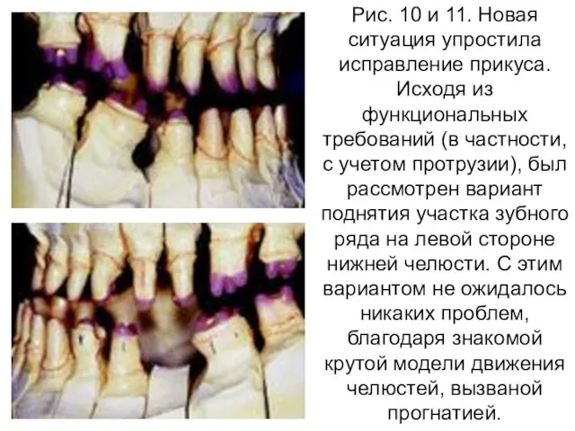 Рис. 10 и 11. Новая ситуация упростила исправление прикуса. Исходя из функциональных