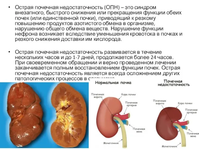 Острая почечная недостаточность (ОПН) – это синдром внезапного, быстрого снижения или прекращения