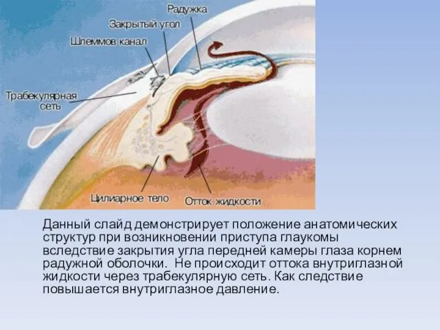 Данный слайд демонстрирует положение анатомических структур при возникновении приступа глаукомы вследствие закрытия