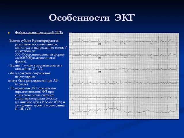 Особенности ЭКГ Фибрилляция предсердий (ФП): -Вместо зубцов Р регистрируются различные по длительности,