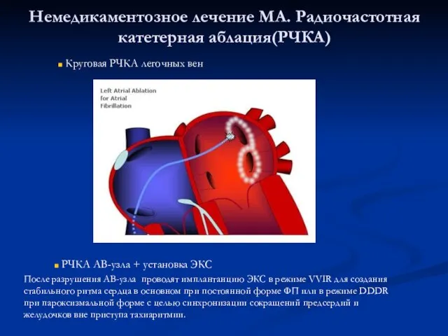 Немедикаментозное лечение МА. Радиочастотная катетерная аблация(РЧКА) Круговая РЧКА легочных вен РЧКА АВ-узла