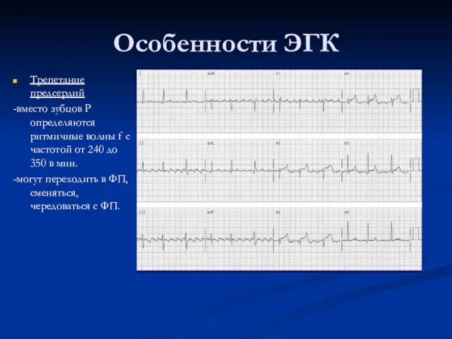 Особенности ЭГК Трепетание предсердий -вместо зубцов Р определяются ритмичные волны f с