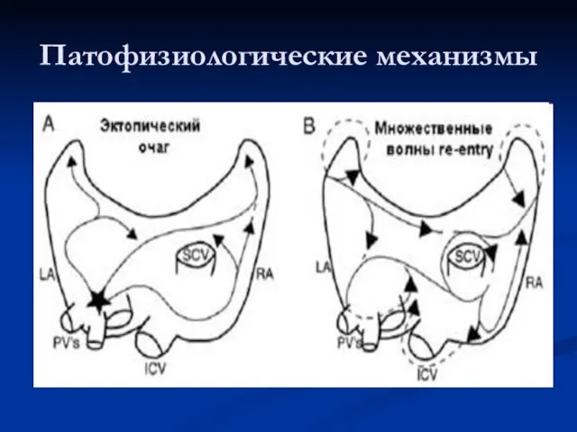 Патофизиологические механизмы