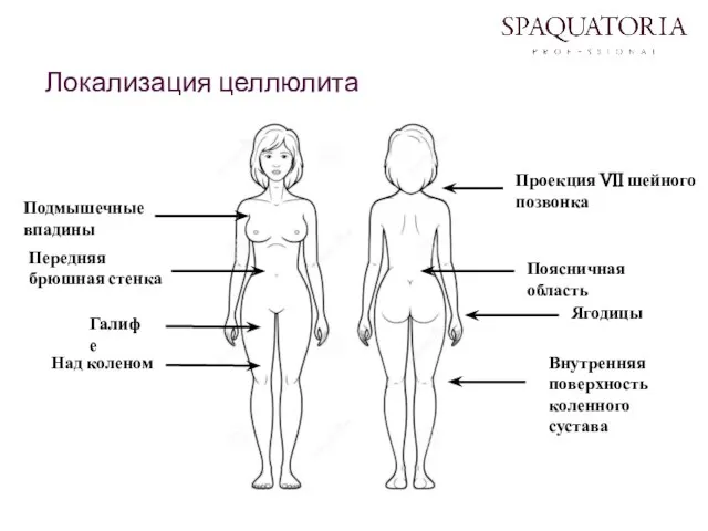 Локализация целлюлита Проекция VII шейного позвонка Передняя брюшная стенка Поясничная область Ягодицы