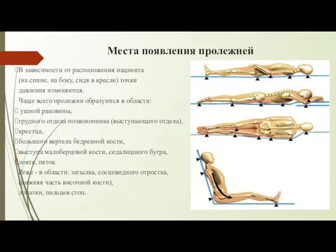 Места появления пролежней В зависимости от расположения пациента (на спине, на боку,