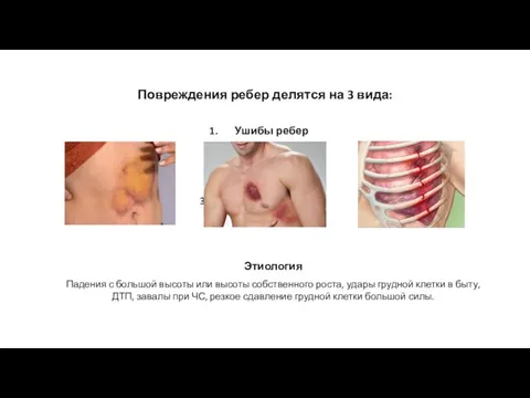 Повреждения ребер делятся на 3 вида: Ушибы ребер Трещины ребер Переломы ребер