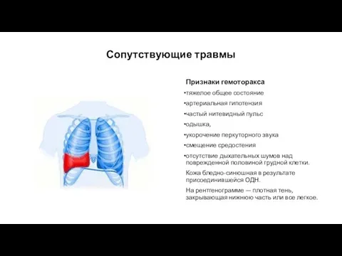 Признаки гемоторакса тяжелое общее состояние артериальная гипотензия частый нитевидный пульс одышка, укорочение