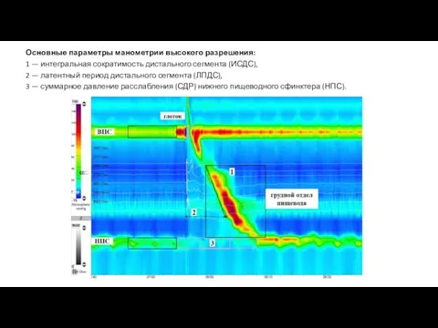 Основные параметры манометрии высокого разрешения: 1 — интегральная сократимость дистального сегмента (ИСДС),