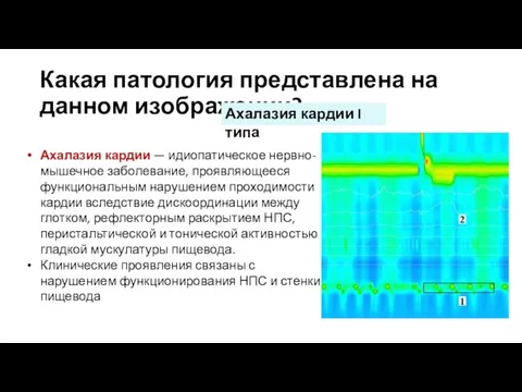 Какая патология представлена на данном изображении? Ахалазия кардии — идиопатическое нервно-мышечное заболевание,