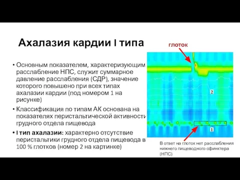 Ахалазия кардии I типа Основным показателем, характеризующим расслабление НПС, служит суммарное давление