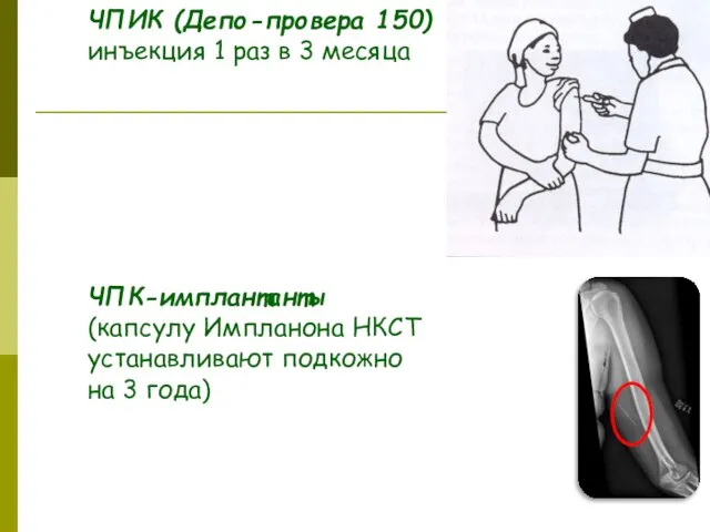 ЧПИК (Депо-провера 150) инъекция 1 раз в 3 месяца ЧПК-имплантанты (капсулу Импланона