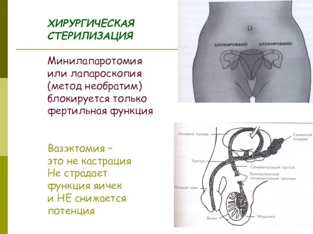 ХИРУРГИЧЕСКАЯ СТЕРИЛИЗАЦИЯ Минилапаротомия или лапароскопия (метод необратим) блокируется только фертильная функция Вазэктомия