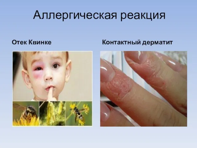 Аллергическая реакция Отек Квинке Контактный дерматит