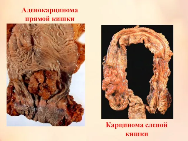 Аденокарцинома прямой кишки Карцинома слепой кишки