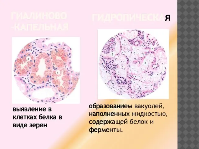 ГИАЛИНОВО-КАПЕЛЬНАЯ ГИДРОПИЧЕСКАя образованием вакуолей, наполненных жидкостью, содержащей белок и ферменты. выявление в