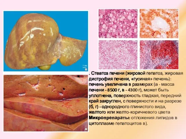 . Стеатоз печени (жировой гепатоз, жировая дистрофия печени, «гусиная» печень): печень увеличена