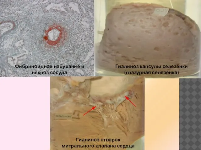Фибриноидное набухание и некроз сосуда Гиалиноз капсулы селезёнки (глазурная селезёнка) Гиалиноз створок митрального клапана сердца