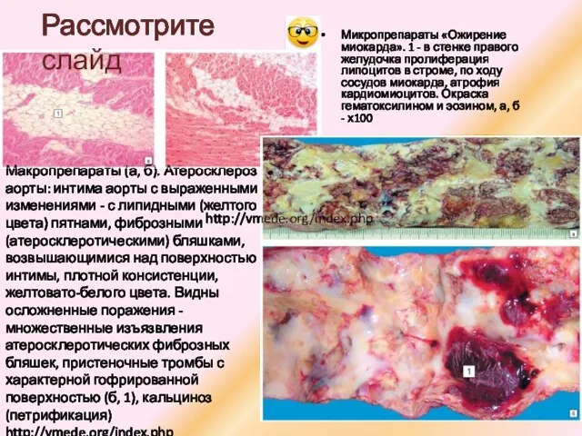 Микропрепараты «Ожирение миокарда». 1 - в стенке правого желудочка пролиферация липоцитов в