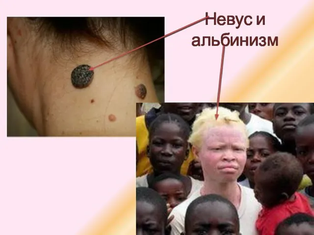 Невус и альбинизм