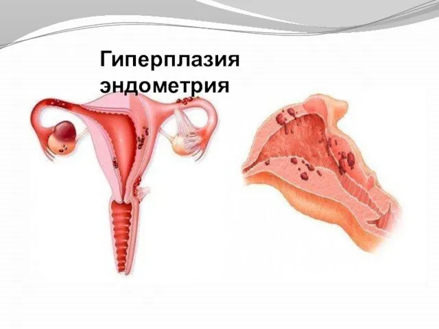 Гиперплазия эндометрия