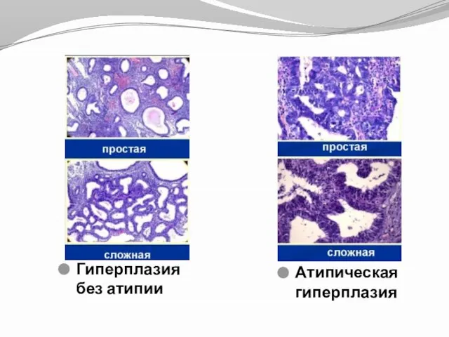 Гиперплазия без атипии Атипическая гиперплазия