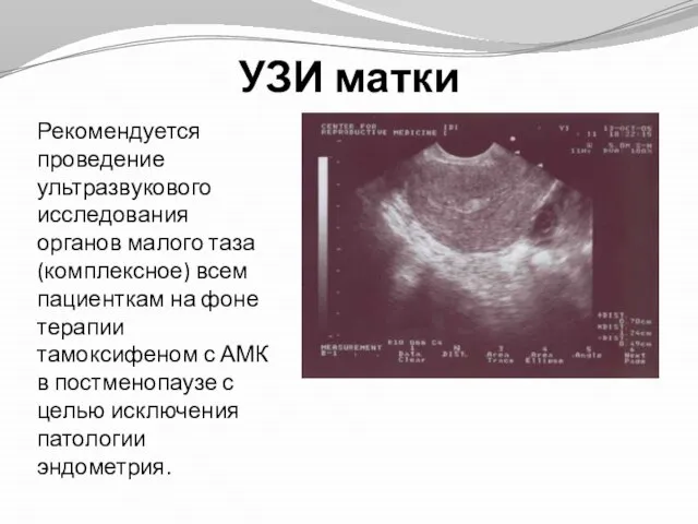 УЗИ матки Рекомендуется проведение ультразвукового исследования органов малого таза (комплексное) всем пациенткам