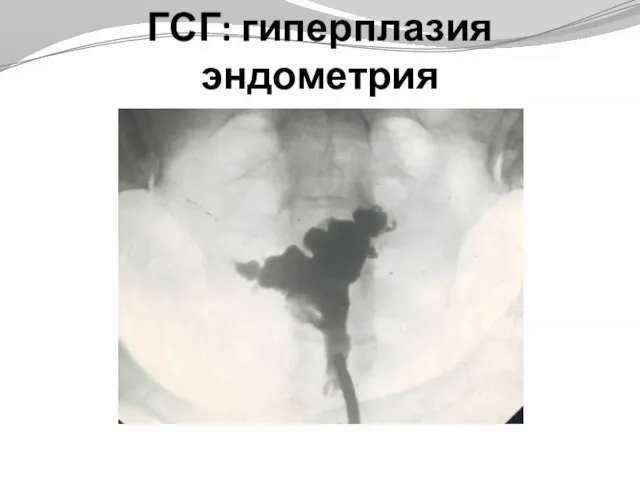 ГСГ: гиперплазия эндометрия