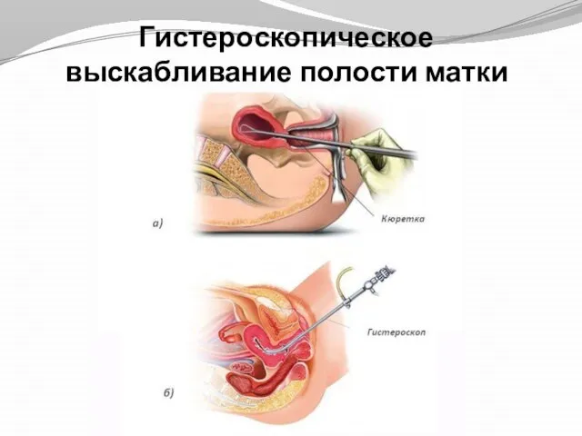 Гистероскопическое выскабливание полости матки