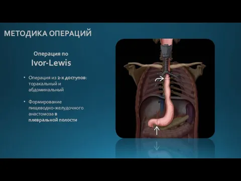 МЕТОДИКА ОПЕРАЦИЙ Операция по Ivor-Lewis Операция из 2-х доступов: торакальный и абдоминальный