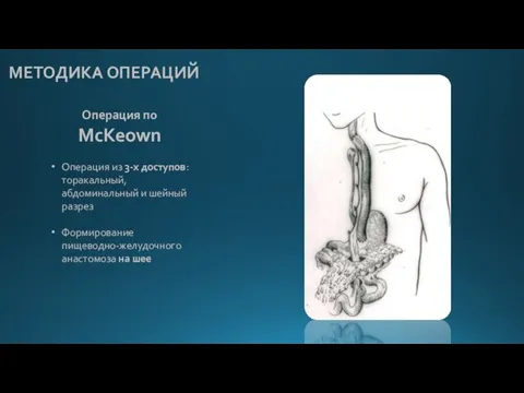 Операция по McKeown Операция из 3-х доступов: торакальный, абдоминальный и шейный разрез