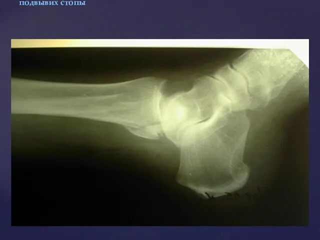 Рентгенограмма голеностопного сустава в боковой проекции: перелом (отрыв) задней поверхности большеберцовой кости, подвывих стопы