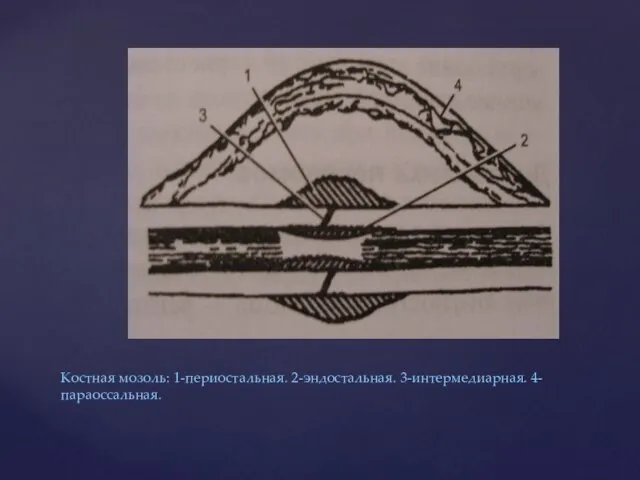 Костная мозоль: 1-периостальная. 2-эндостальная. 3-интермедиарная. 4-параоссальная.