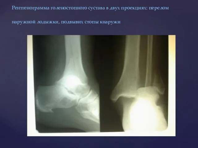 Рентгенограмма голеностопного сустава в двух проекциях: перелом наружной лодыжки, подвывих стопы кнаружи