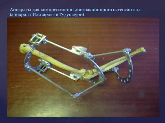 Аппараты для компрессионно-дистракционного остеосинтеза (аппараты Илизарова и Гудушаури)