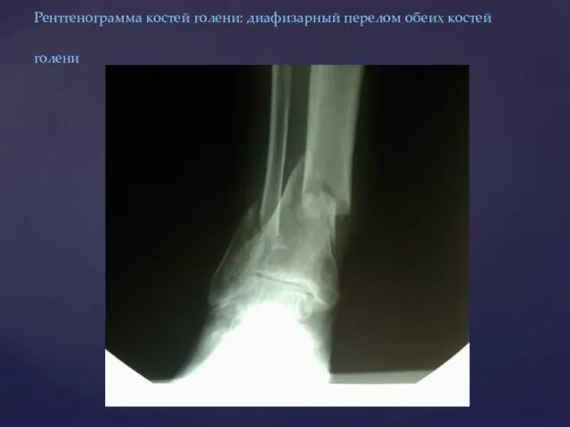 Рентгенограмма костей голени: диафизарный перелом обеих костей голени