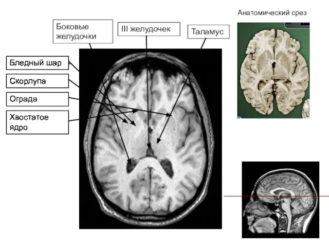 Анатомический срез Таламус III желудочек Боковые желудочки Хвостатое ядро Ограда Скорлупа Бледный
