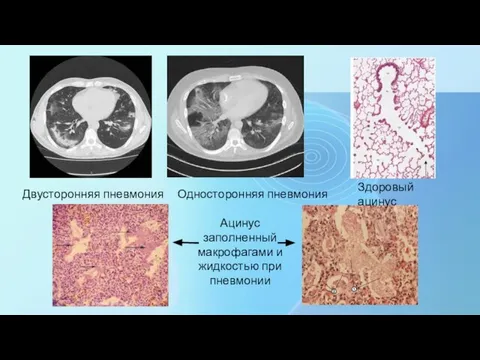 Двусторонняя пневмония Односторонняя пневмония Здоровый ацинус Ацинус заполненный макрофагами и жидкостью при пневмонии