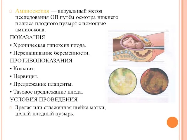 Амниоскопия — визуальный метод исследования ОВ путём осмотра нижнего полюса плодного пузыря