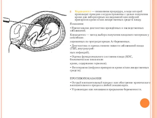 Кордоцентез — инвазивная процедура, в ходе которой производят пункцию сосудов пуповины с