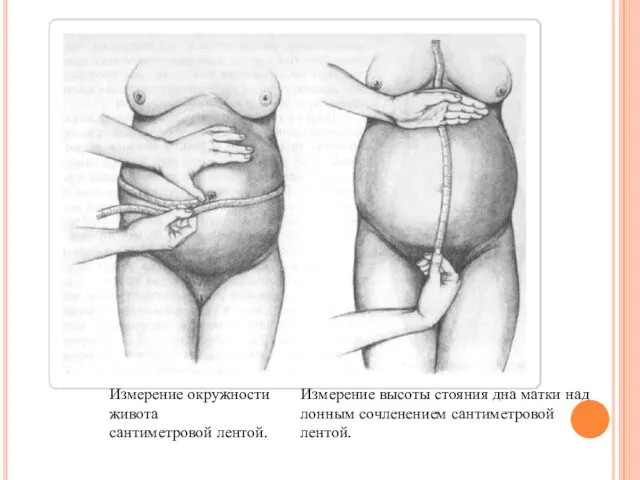 Измерение окружности живота сантиметровой лентой. Измерение высоты стояния дна матки над лонным сочленением сантиметровой лентой.