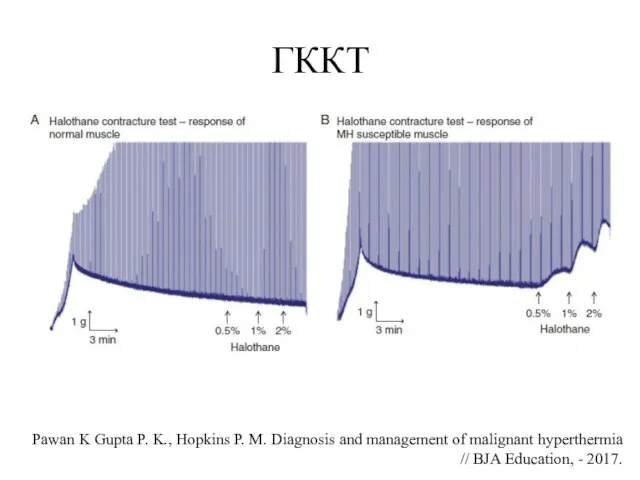 ГККТ Pawan K Gupta P. K., Hopkins P. M. Diagnosis and management