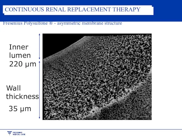 Wall thickness 35 µm Inner lumen 220 µm Fresenius Polysulfone ® -