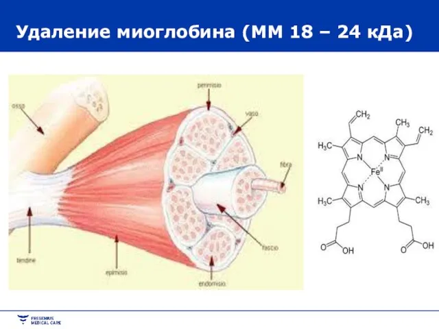 Удаление миоглобина (ММ 18 – 24 кДа)