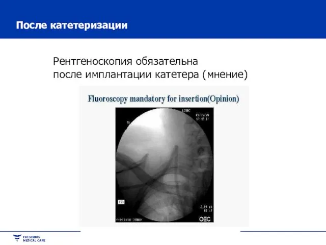 После катетеризации Рентгеноскопия обязательна после имплантации катетера (мнение)