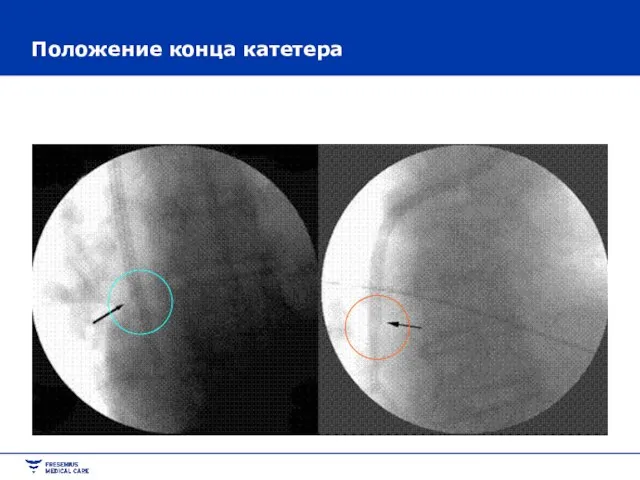 Положение конца катетера