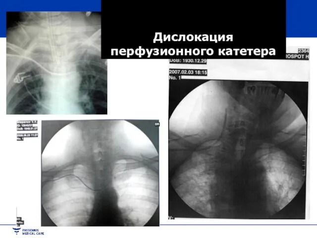 Дислокация перфузионного катетера