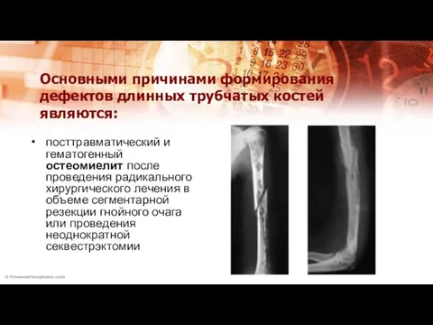 Основными причинами формирования дефектов длинных трубчатых костей являются: посттравматический и гематогенный остеомиелит