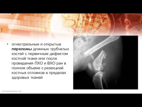 огнестрельные и открытые переломы длинных трубчатых костей с первичным дефектом костной ткани