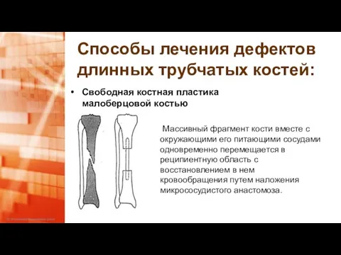Способы лечения дефектов длинных трубчатых костей: Свободная костная пластика малоберцовой костью Массивный